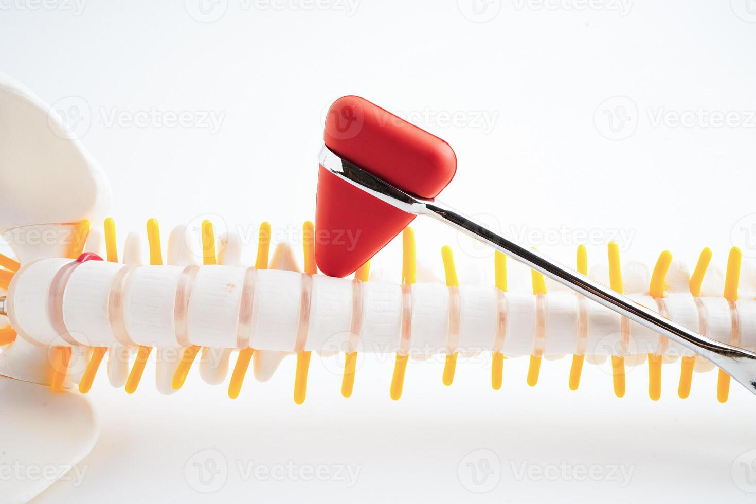 Spinal nerve and bone with knee reflex hammer, Lumbar spine displaced herniated disc fragment, Model for treatment medical in the orthopedic department. photo