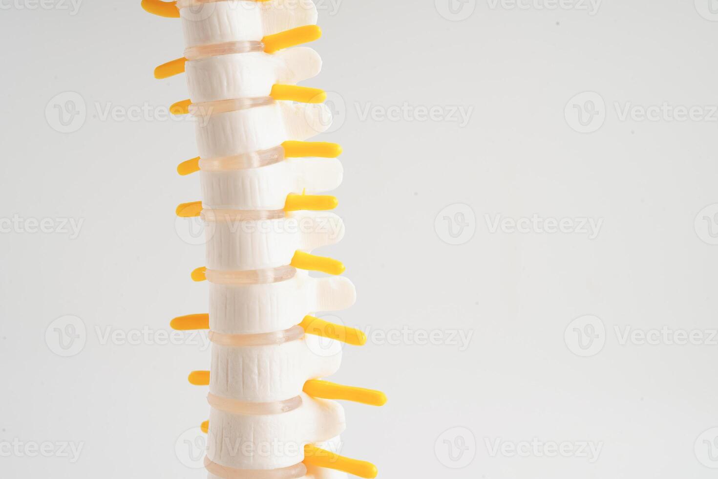 Spinal nerve and bone, Lumbar spine displaced herniated disc fragment, Model for treatment medical in the orthopedic department. photo