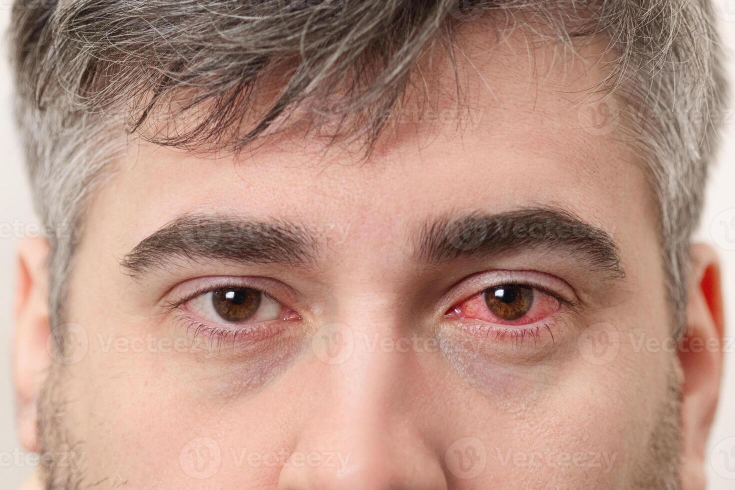 Close up photo of man with red eye.