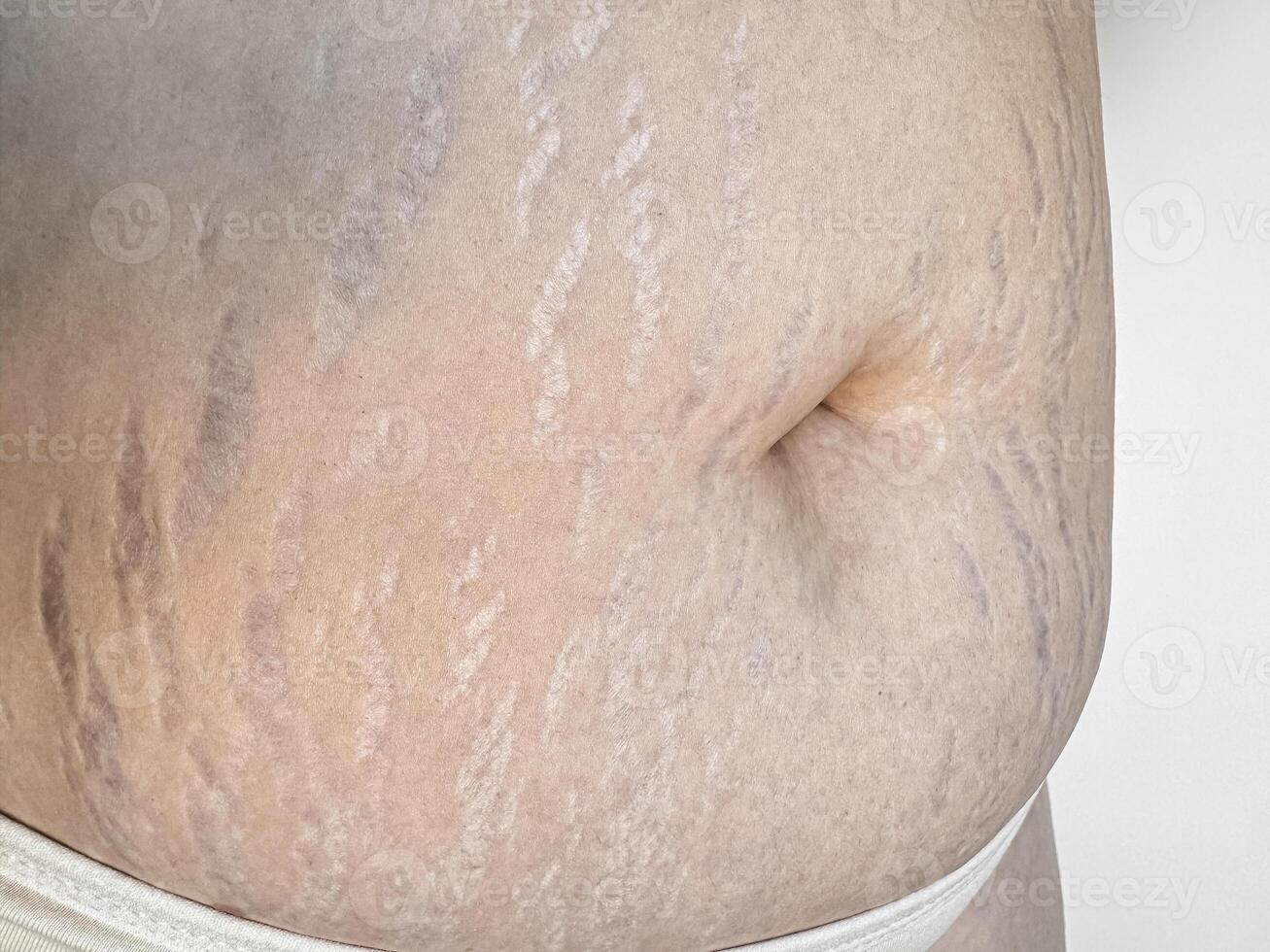 Close up of stretch marks on womans skin, highlighting natural beauty and the concept postpartum changes. photo