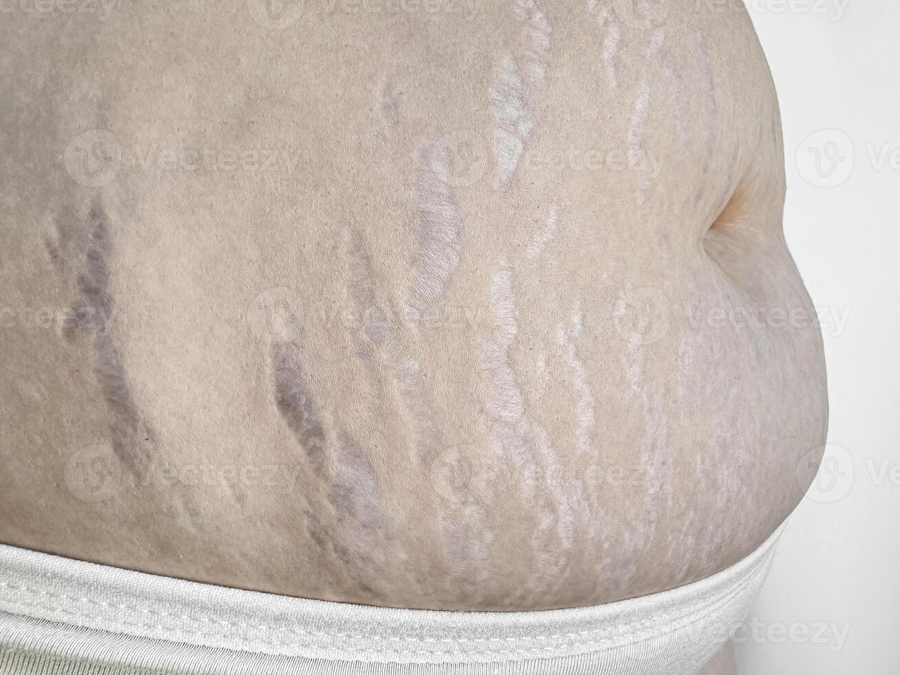 Close up of stretch marks on womans skin, highlighting natural beauty and the concept postpartum changes. photo