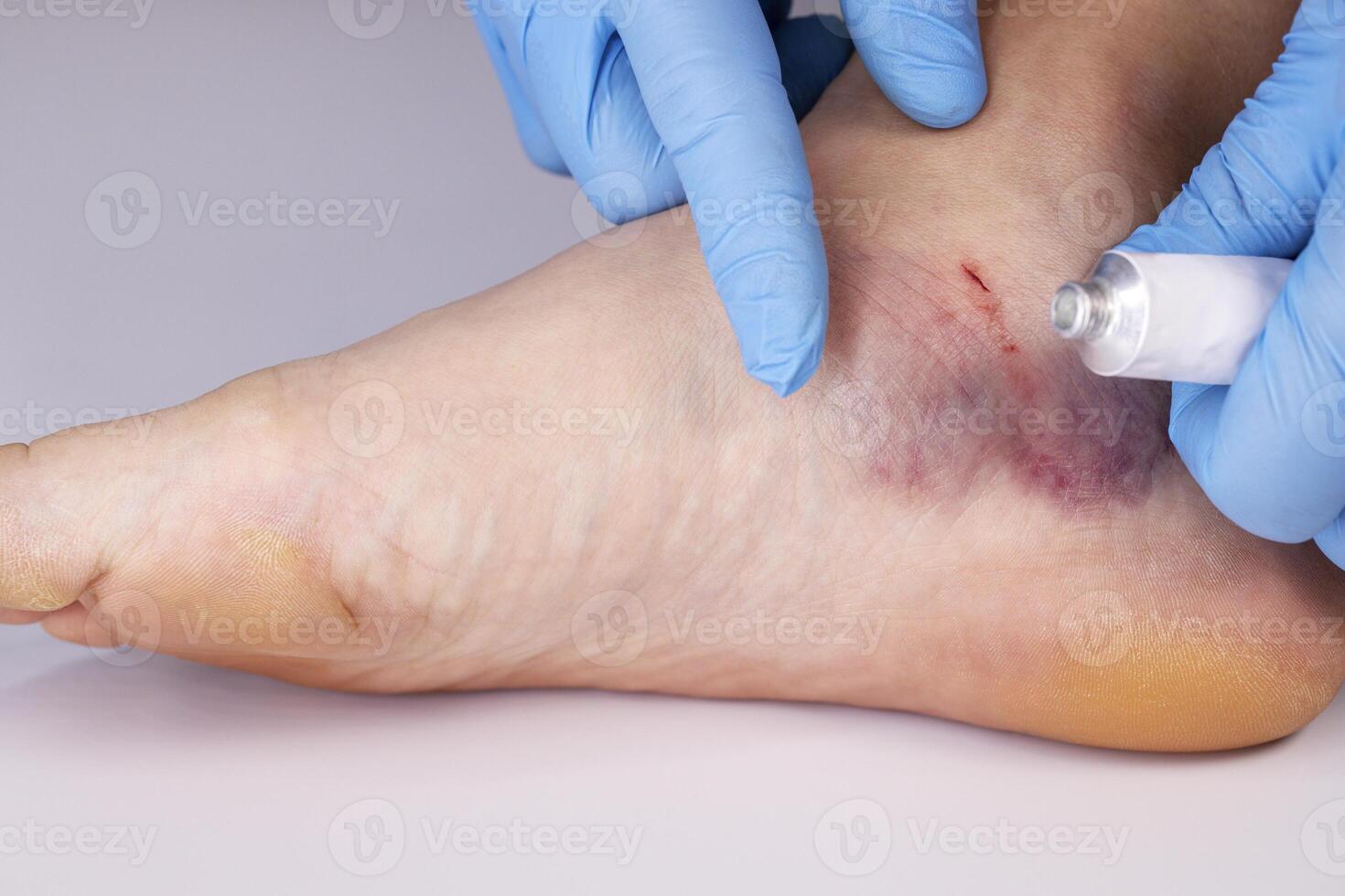 Doctors hands in gloves smear medicinal ointment to bruise on the patients leg photo