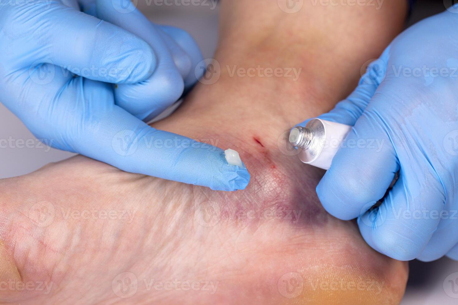 doctores manos en guantes frotis medicinal ungüento a moretón en el pacientes pierna foto