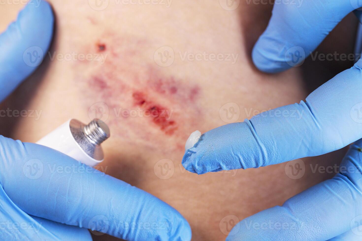 Doctors hands apply medicinal ointment to the bruise on the patients body photo