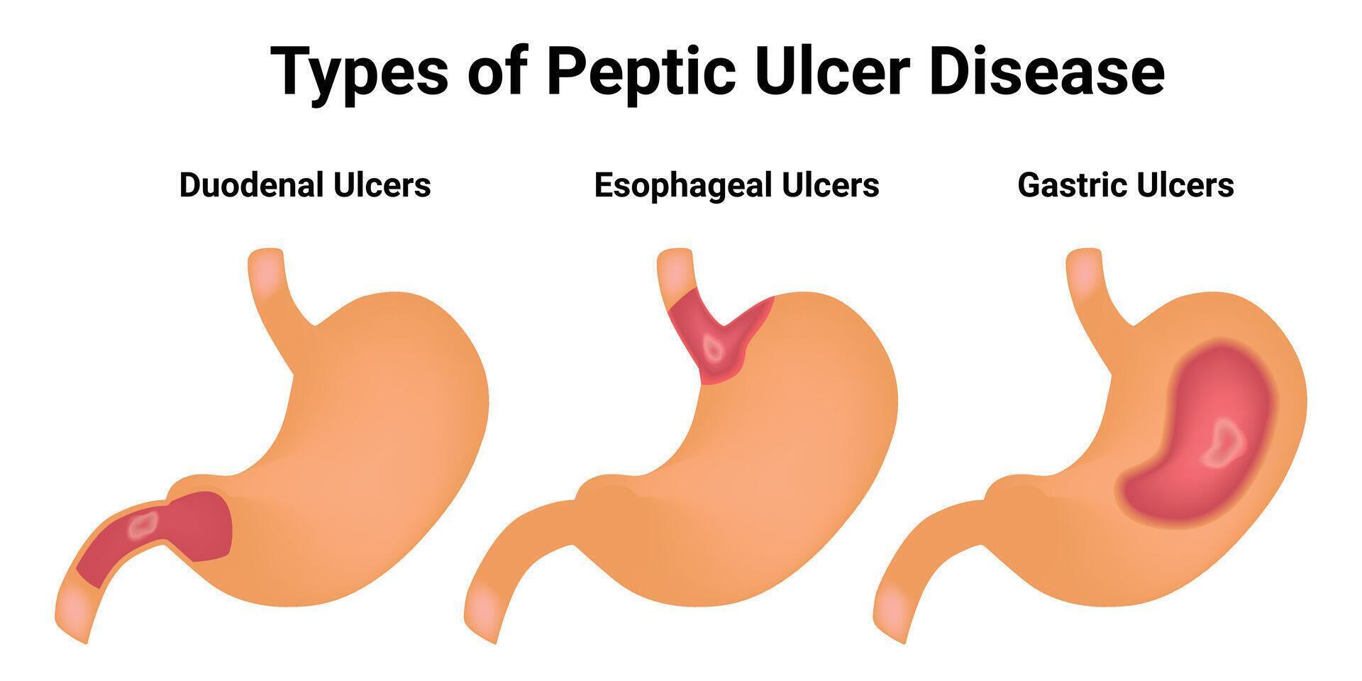 Type of Peptic Ulcer Disease Science Design Vector Illustration