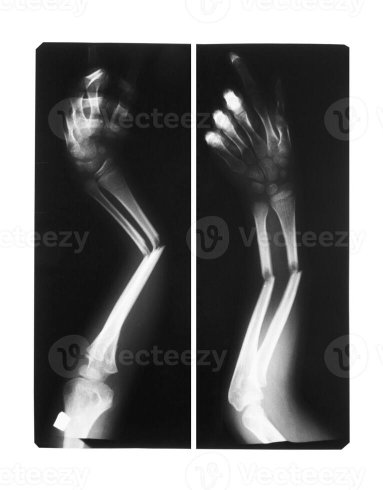 espectáculo doble fractura brazo huesos foto