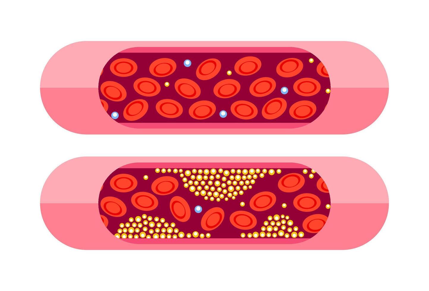 tipos de colesterol. hdl y ldl colesterol tipos etiquetado educativo normal y estrechado artería. vector ilustración