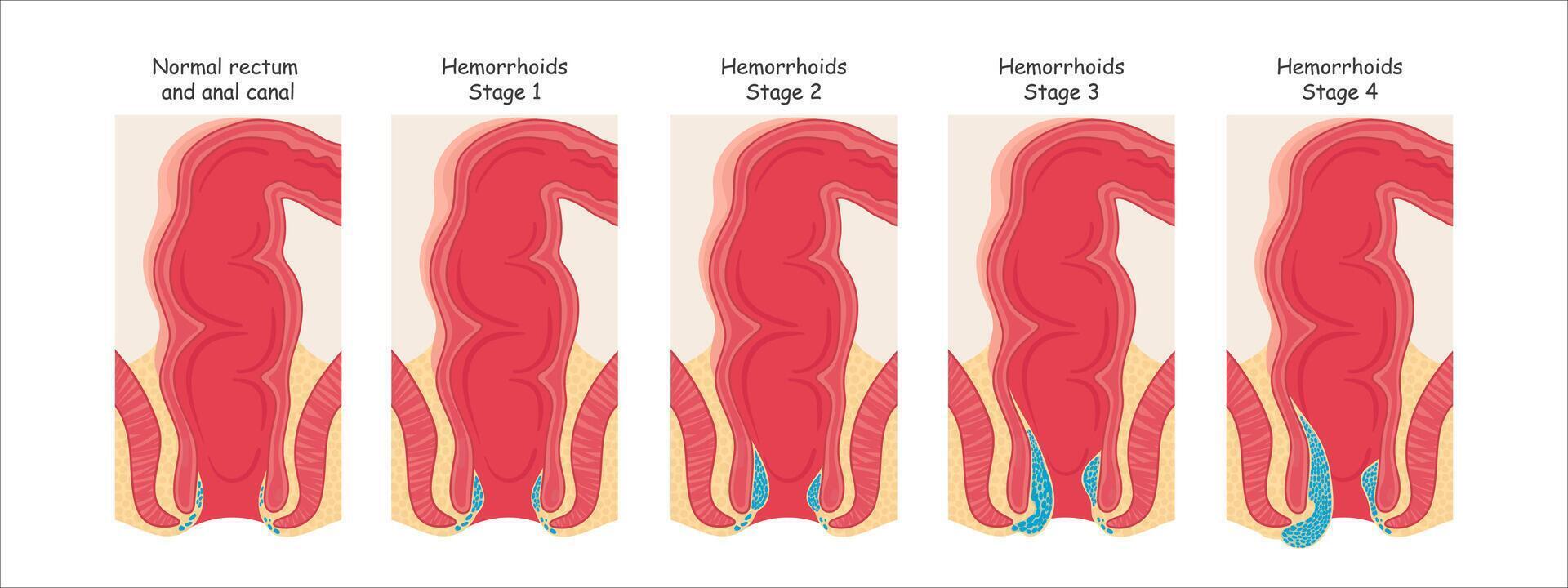 hemorroides en el recto. vector ilustración en dibujos animados estilo.