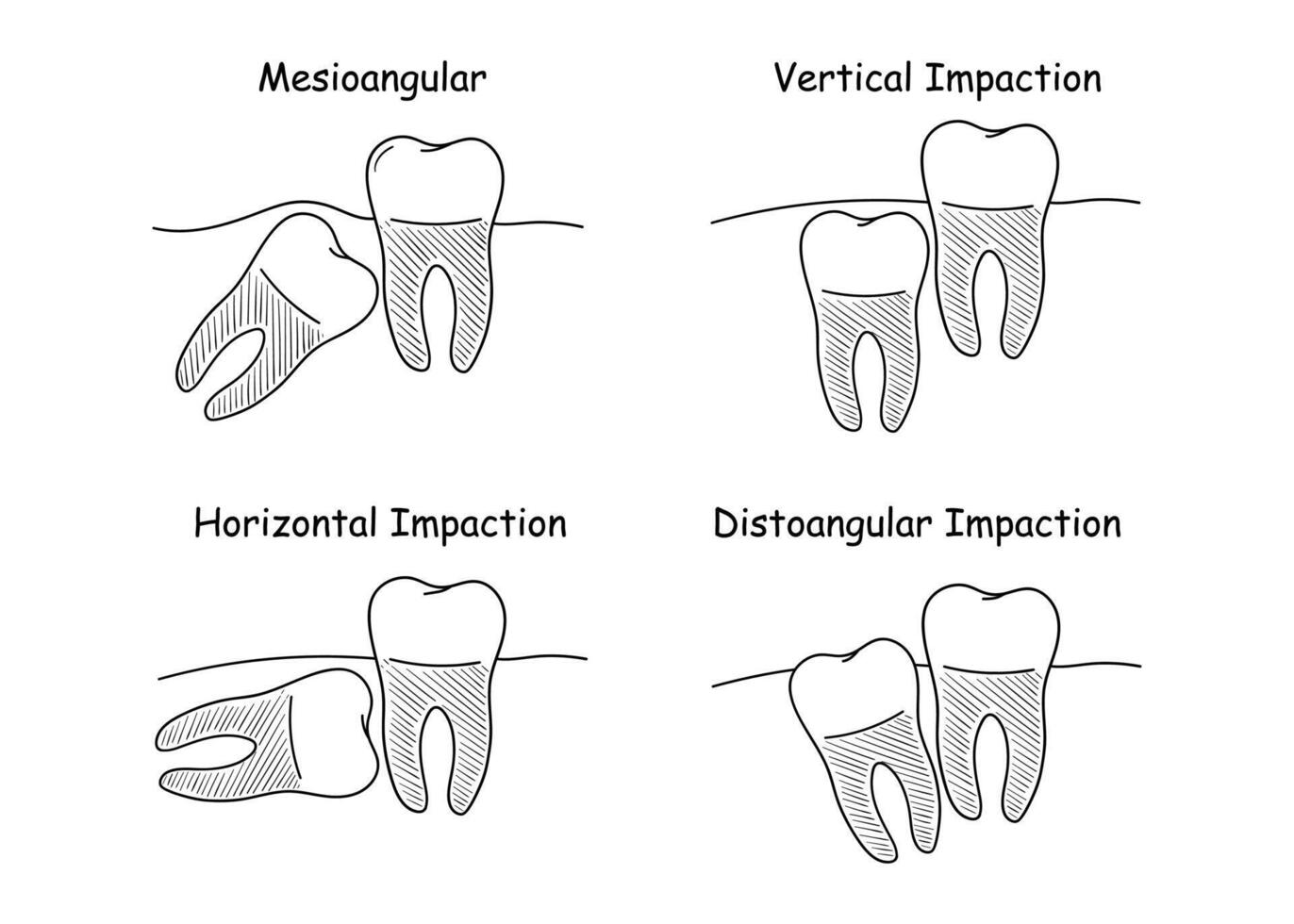 dental anatomía colocar, incorrecto dientes crecimiento, conjunto de vector ilustraciones en garabatear estilo