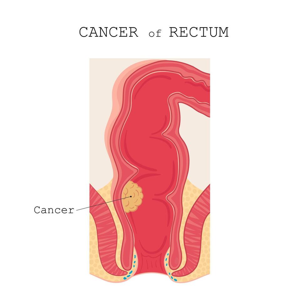 Colon cancer anatomy. illustration diagram in cartoon style. vector