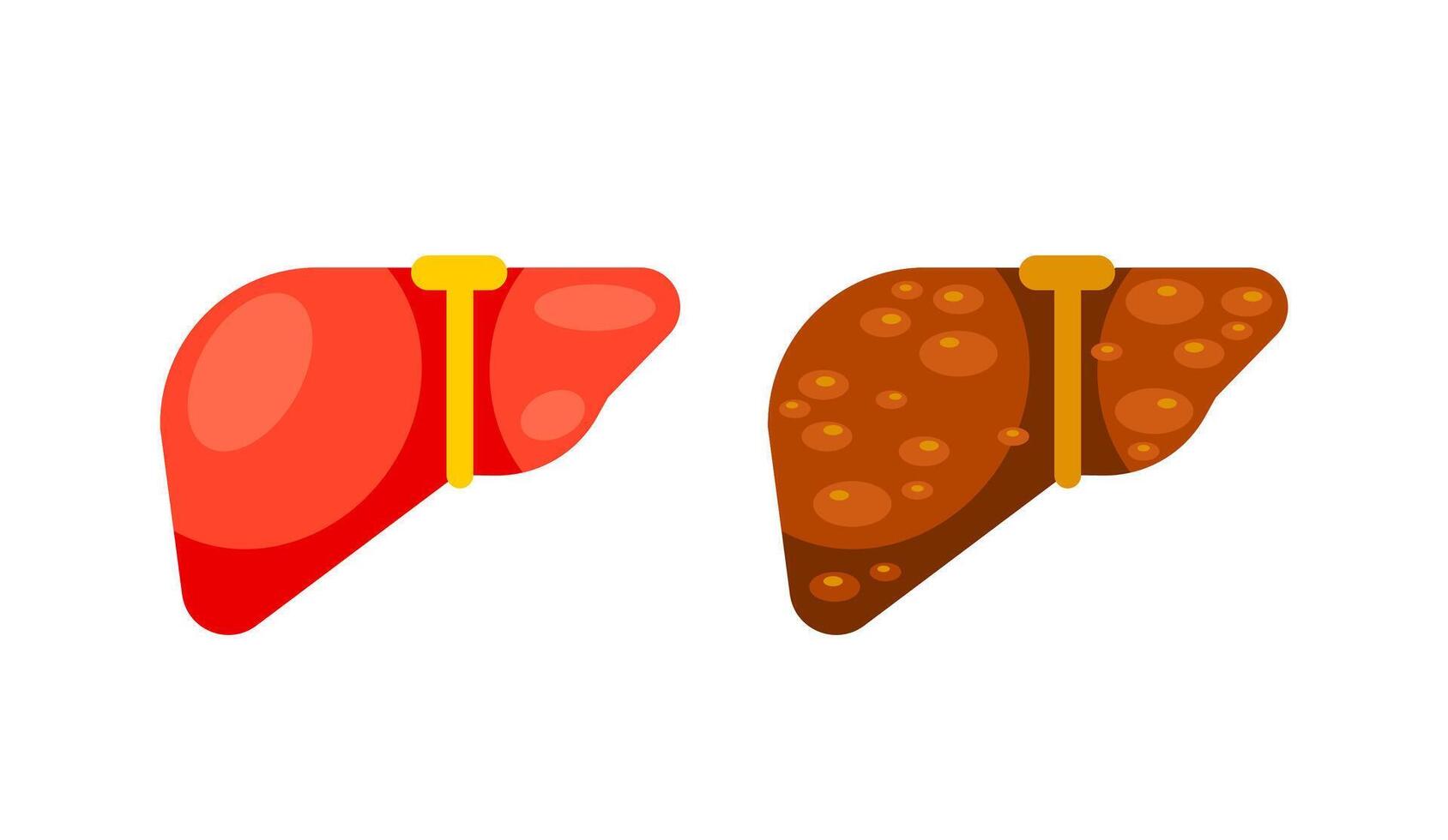 Healthy liver and liver cirrhosis disease. Human liver organ. Vector illustration