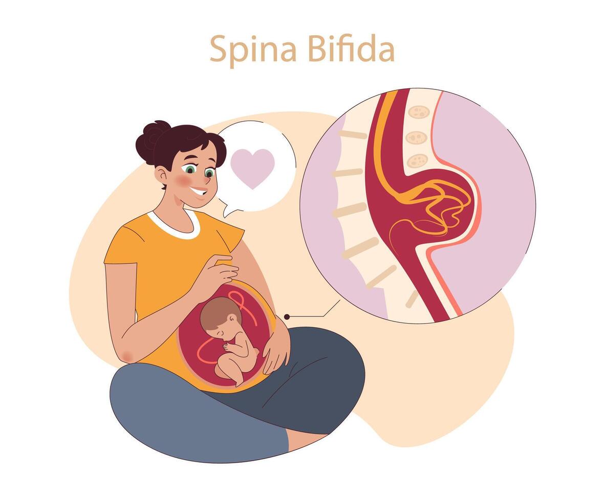 Spina Bifida concept. vector