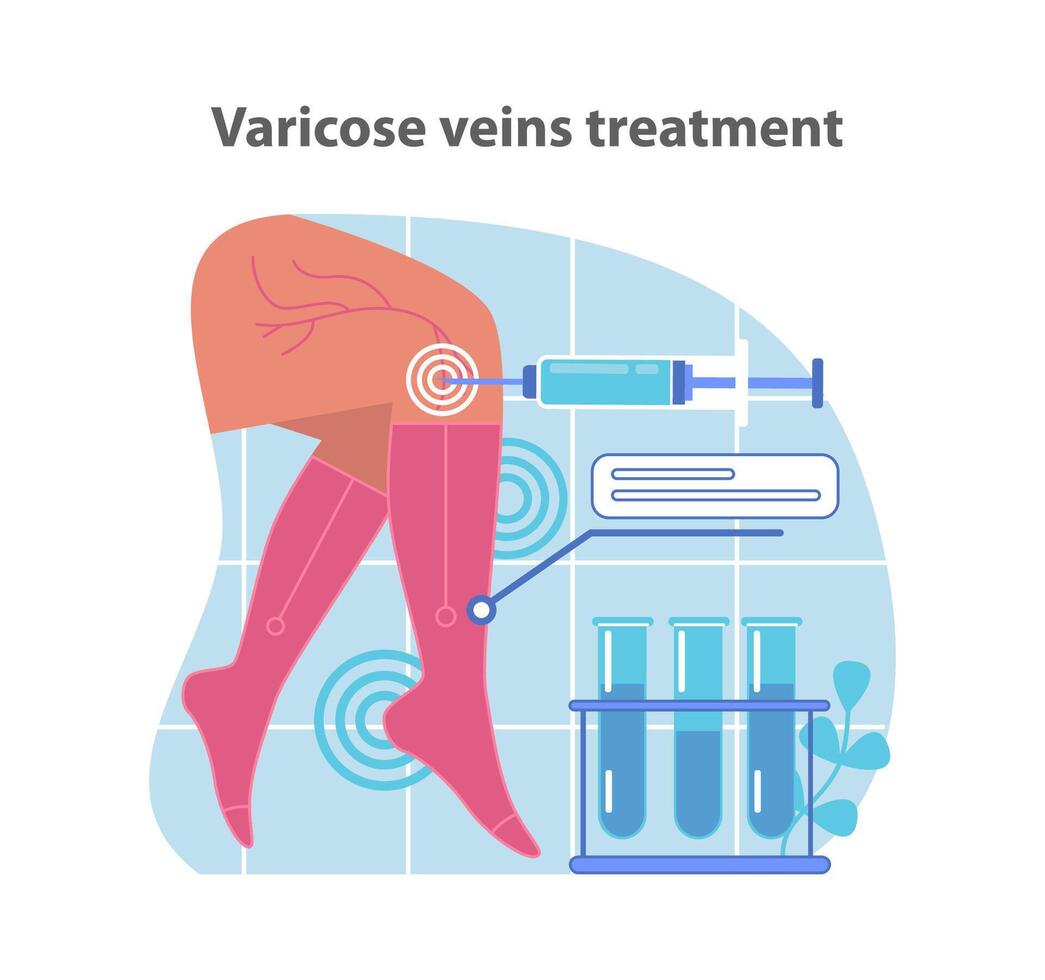 Specialized varicose veins treatment. A medical illustration depicting. vector