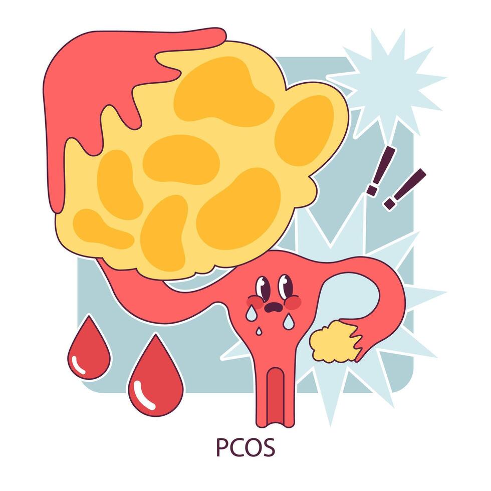 pcos, poliquístico ovario síndrome. hembra reproductivo sistema. endocrino vector