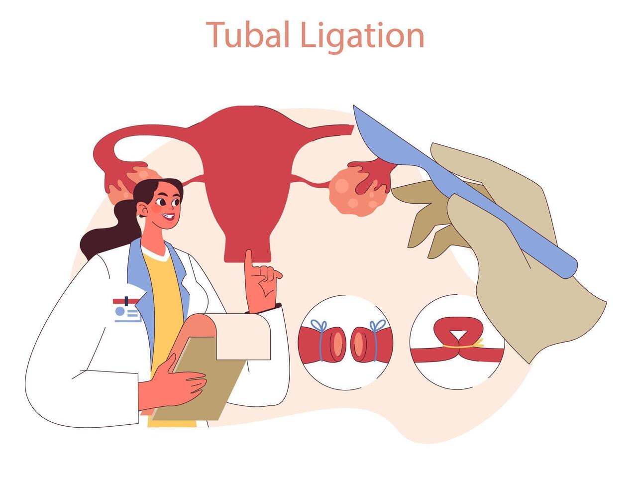 Types of Contraception. Doctor explains tubal ligation as a permanent vector