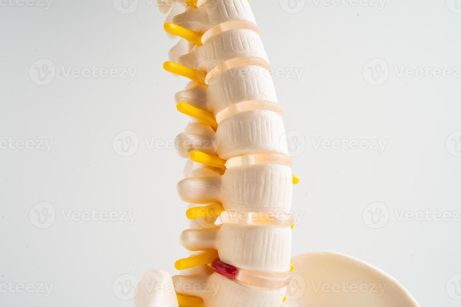 Lumbar spine displaced herniated disc fragment, spinal nerve and bone. Model for treatment medical in the orthopedic department. photo