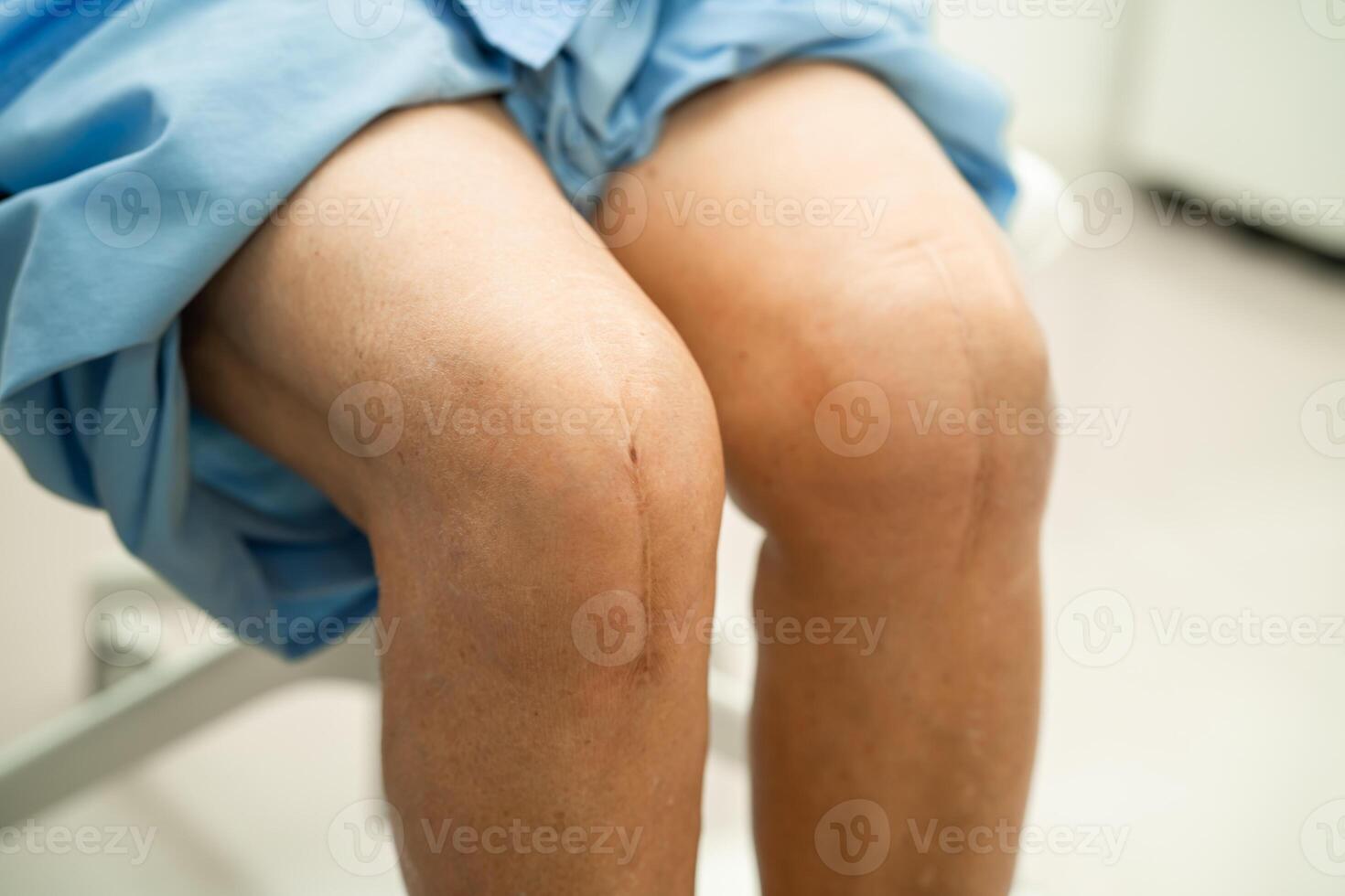 asiático mayor mujer paciente espectáculo su cicatrices quirúrgico total rodilla articulación reemplazo sutura herida cirugía artroplastia en hospital. foto