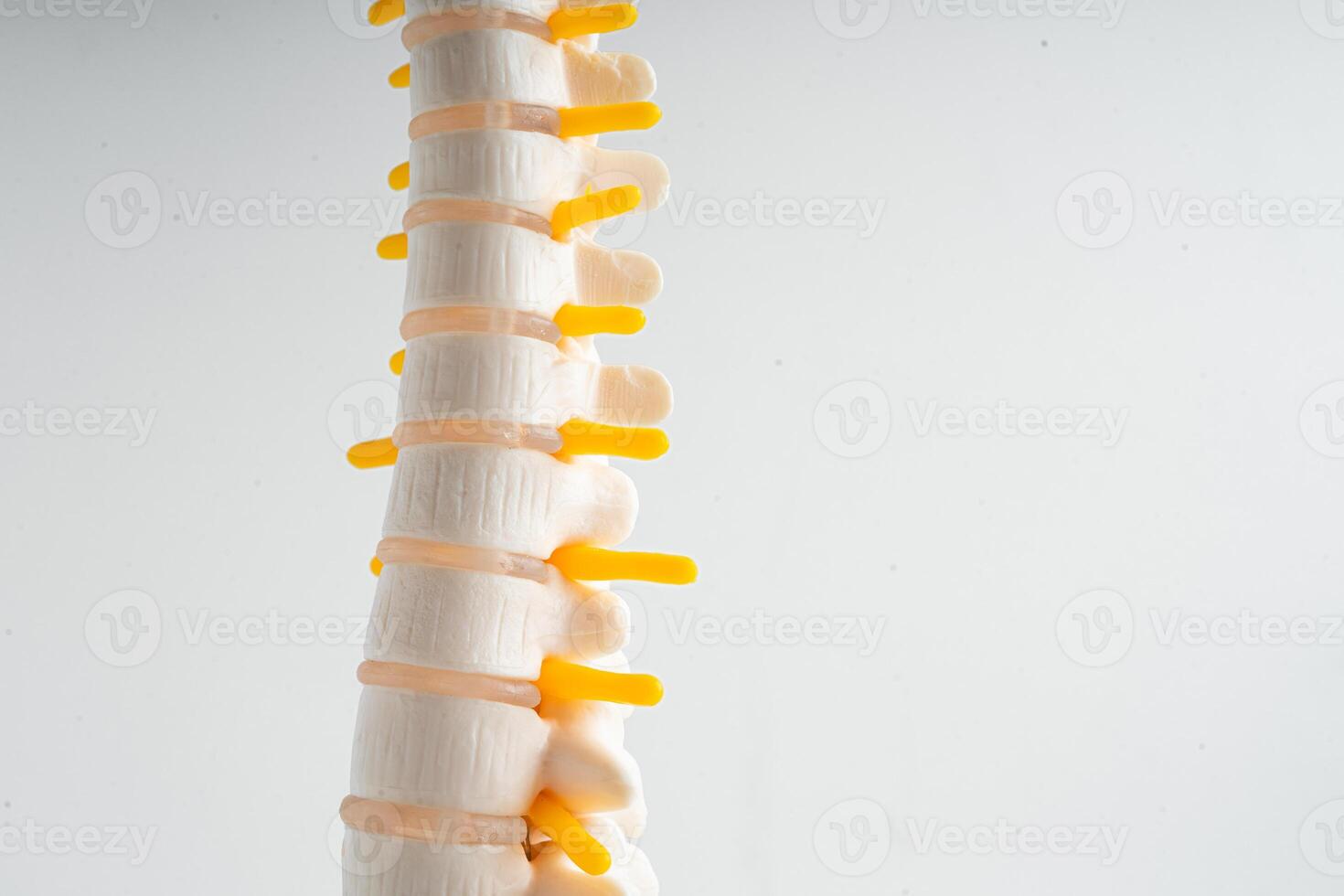 Lumbar spine displaced herniated disc fragment, spinal nerve and bone. Model for treatment medical in the orthopedic department. photo