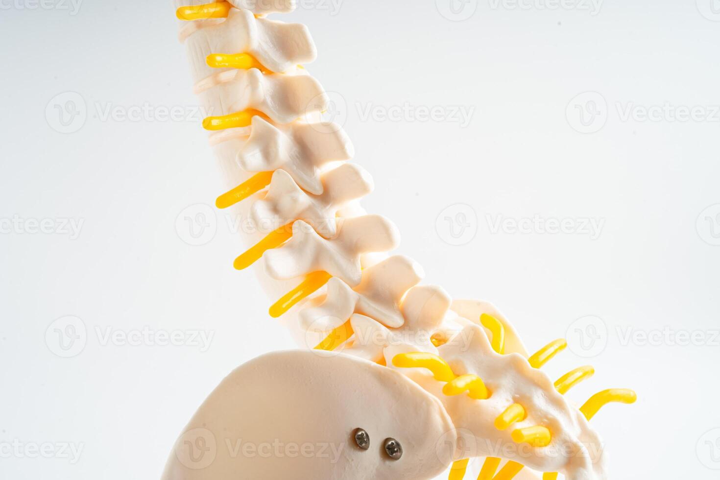 Lumbar spine displaced herniated disc fragment, spinal nerve and bone. Model for treatment medical in the orthopedic department. photo