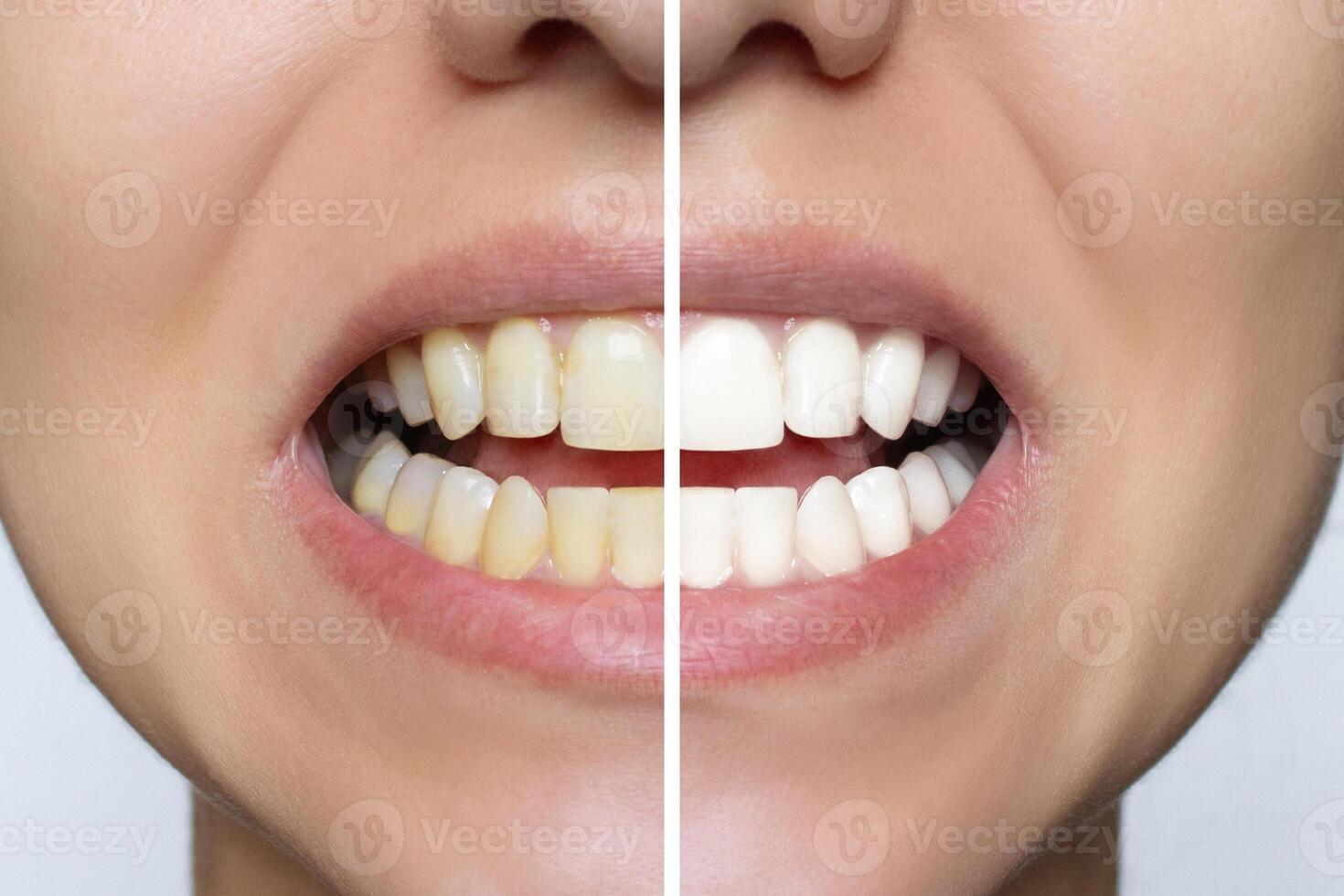 Women's teeth whitening close-up before and after the procedure. Upper and lower jaw. Dental clinic patient. Isolated on white background. Oral care. Dental treatment photo