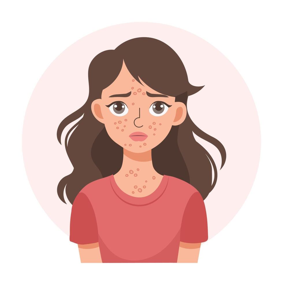 Acne. Unhappy teenage girl with acne and pimples on her face. Irritated facial skin. Illustration, vector