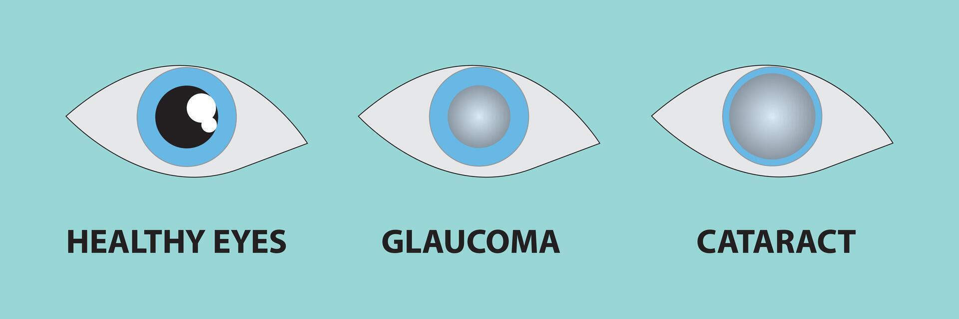 ilustración de un sano ojo, glaucoma, catarata vector