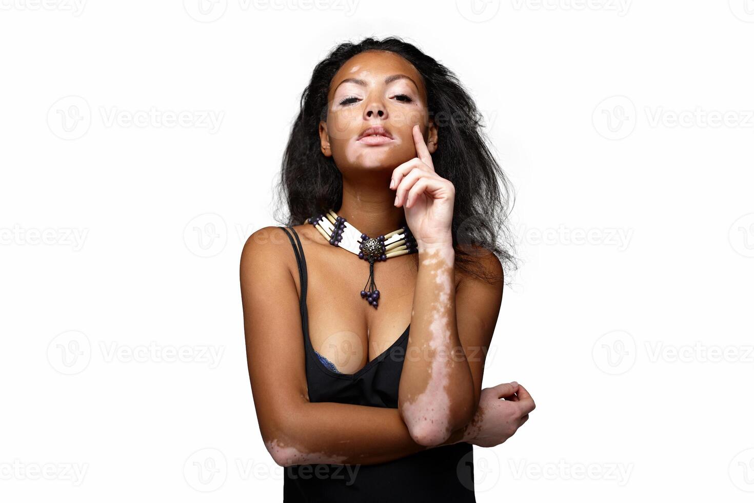 Beautiful African girl in studio with skin problems Vitiligo studio shooting photo