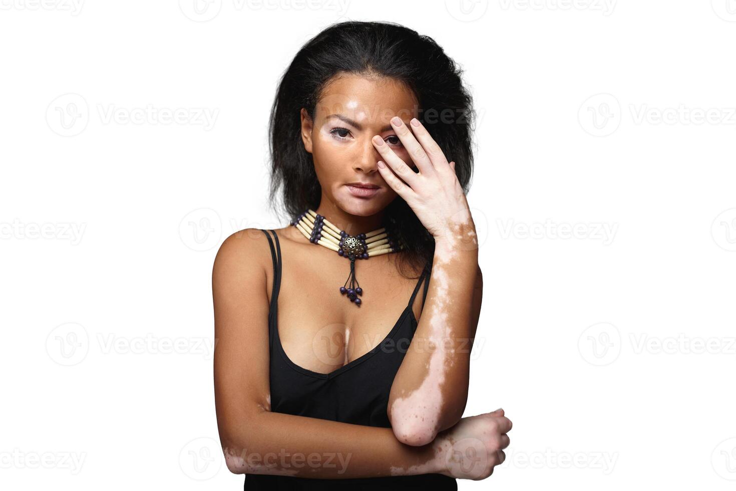 Beautiful African girl in studio with skin problems Vitiligo studio shooting photo