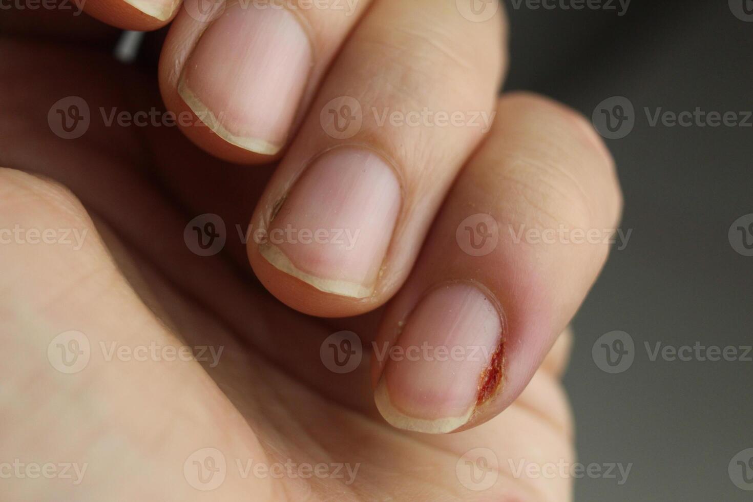 de cerca de el dedos de el izquierda mano con el lesionado pequeño dedo. inflamación de el uña lámina. manicura recuperación uña plato tratamiento foto