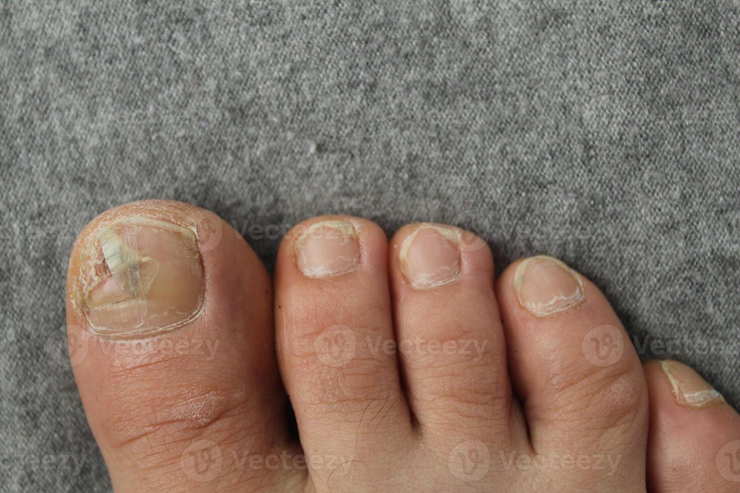 Damaged toenail plate close-up. Nail and skin diseases fungus photo