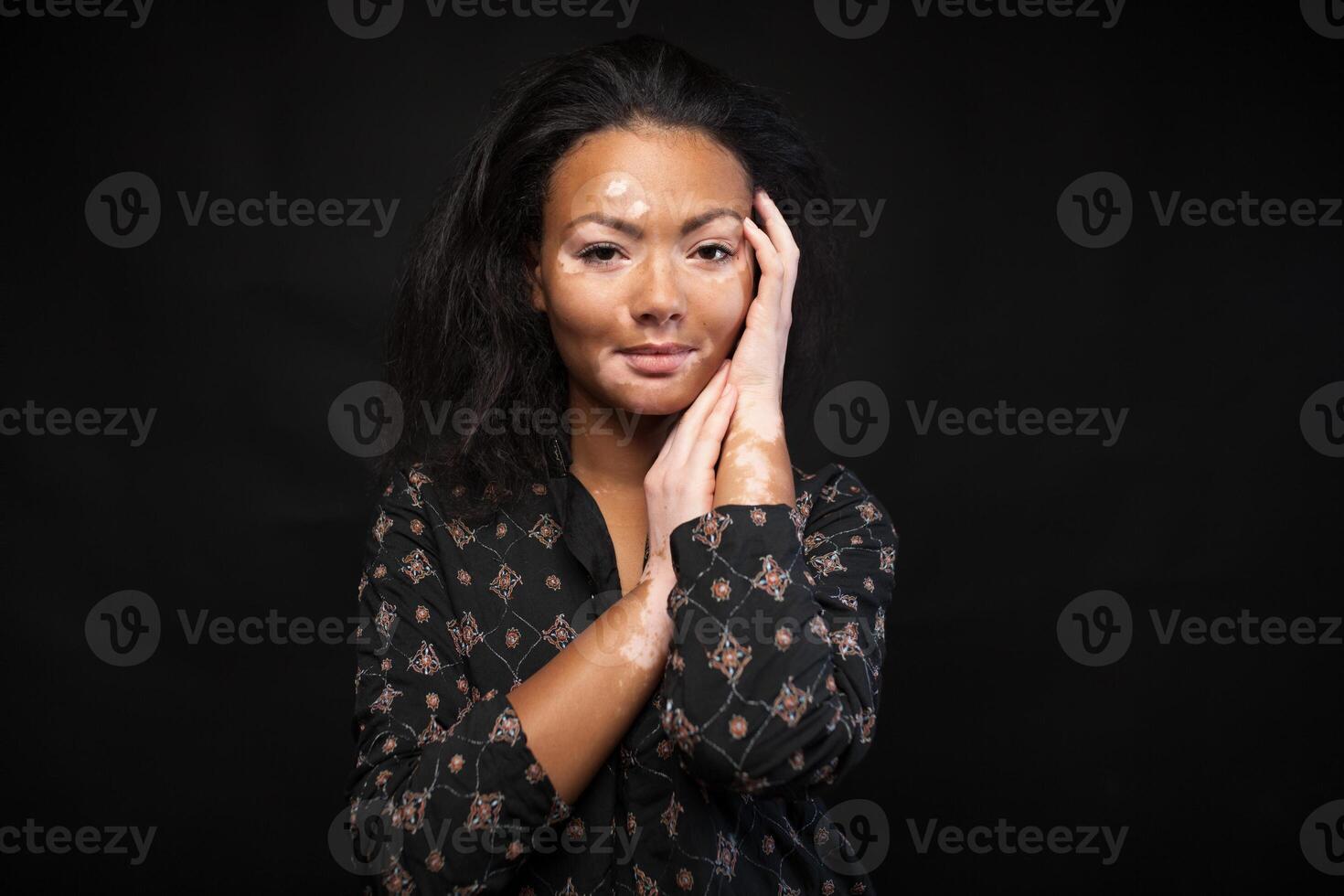Beautiful African girl with skin problems. Vitiligo concept photo