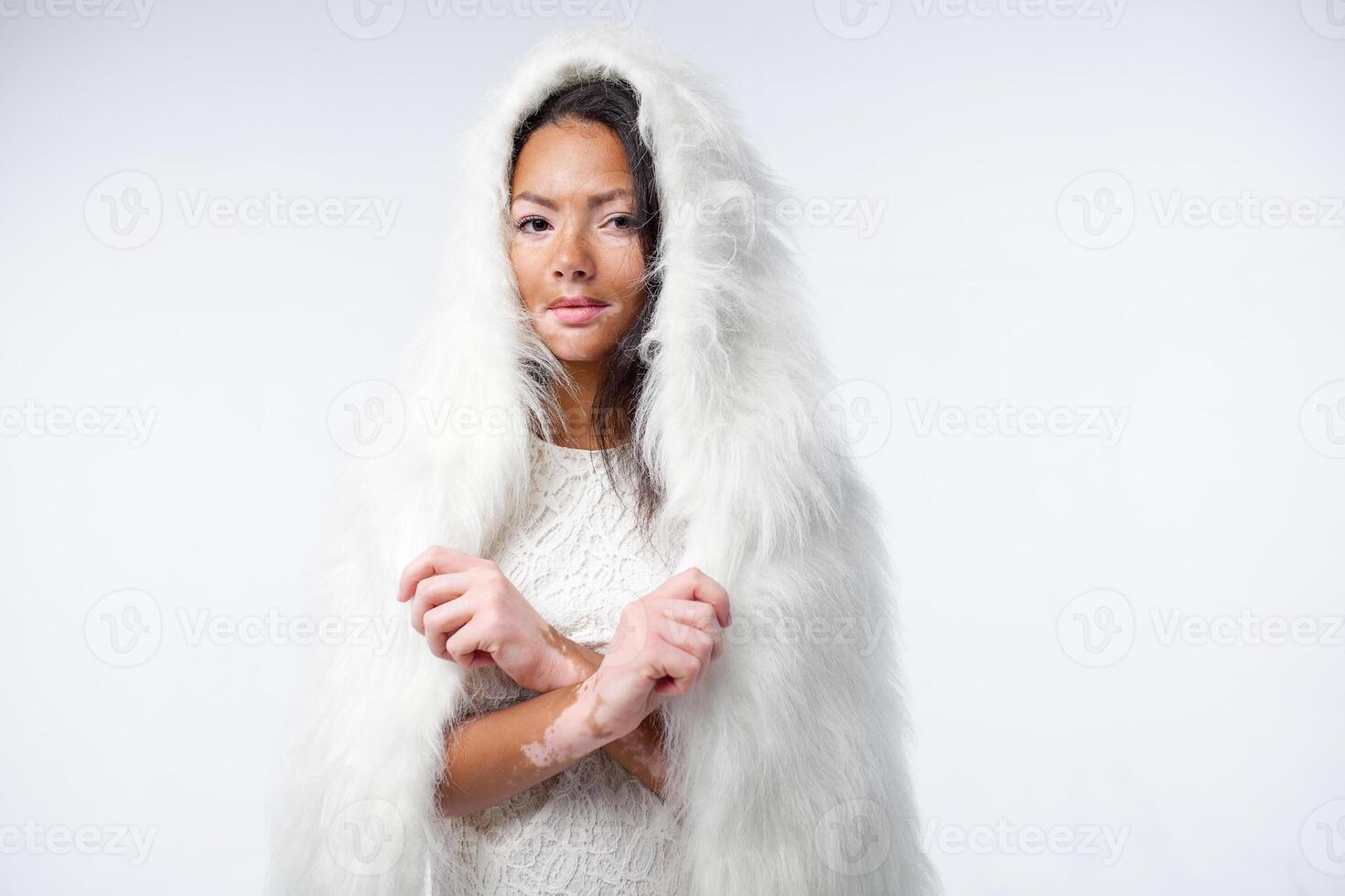 A beautiful African girl with skin problems is dressed in warm white faux fur. Vitiligo concept photo