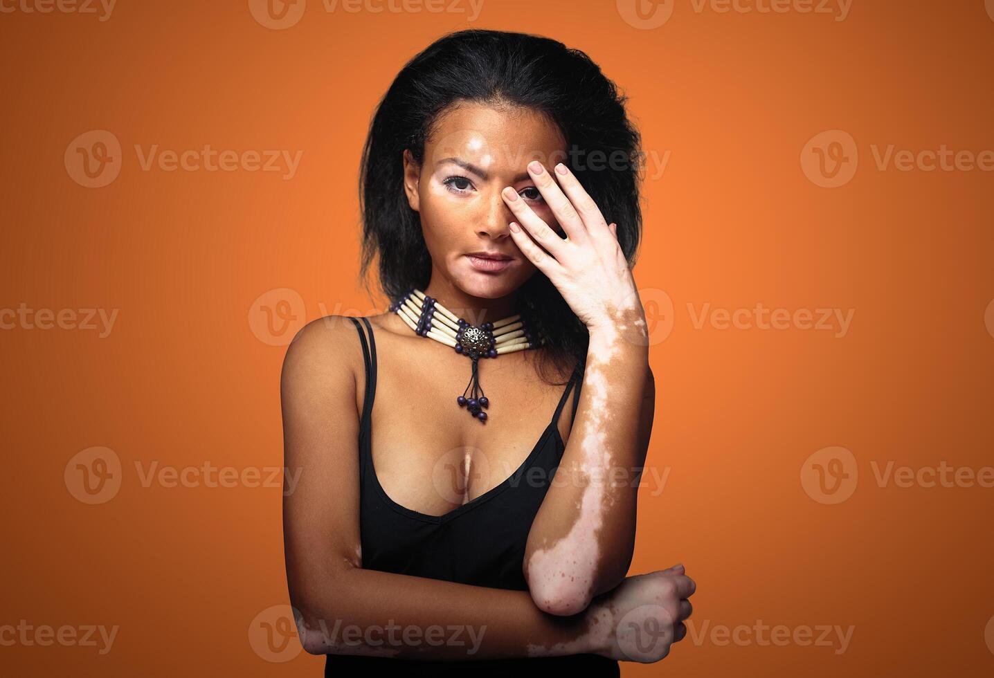 Beautiful African girl in studio with skin problems Vitiligo studio shooting photo