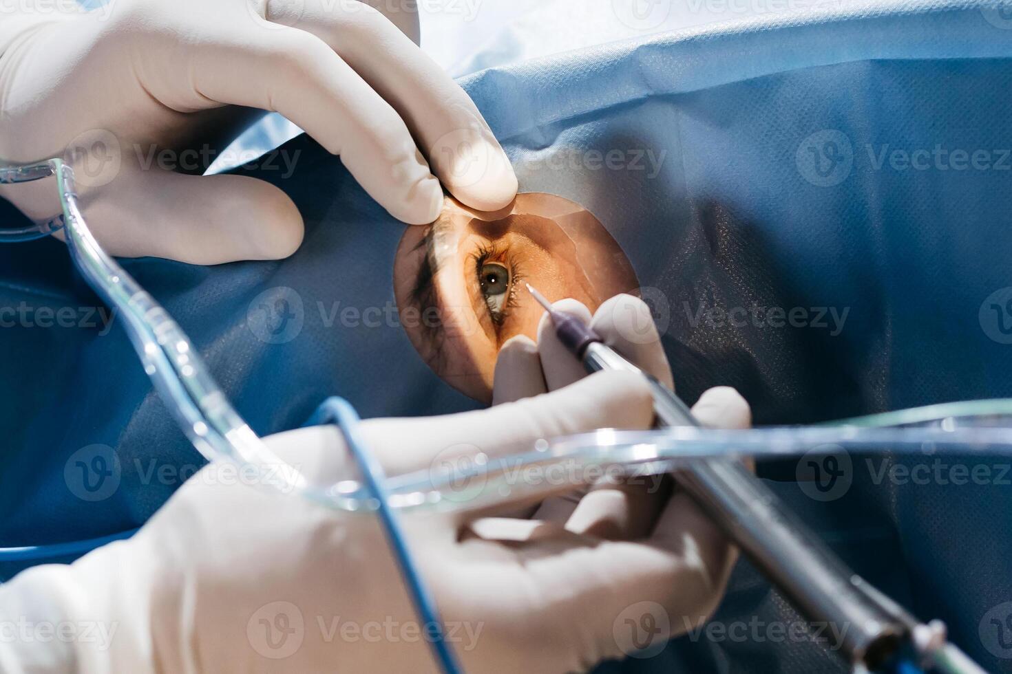 Vision correction with microscope. Surgeon's hands in gloves performing laser eye vision correction. ophthalmology , medicine, people health concept photo