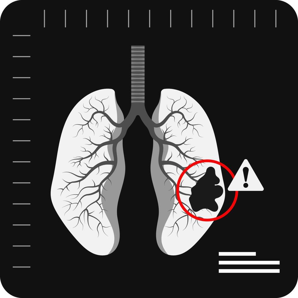 Lungs damaged x ray icon, concept flat style. Internal organs of the human design element, logo. Anatomy, medicine concept. Healthcare vector illustration