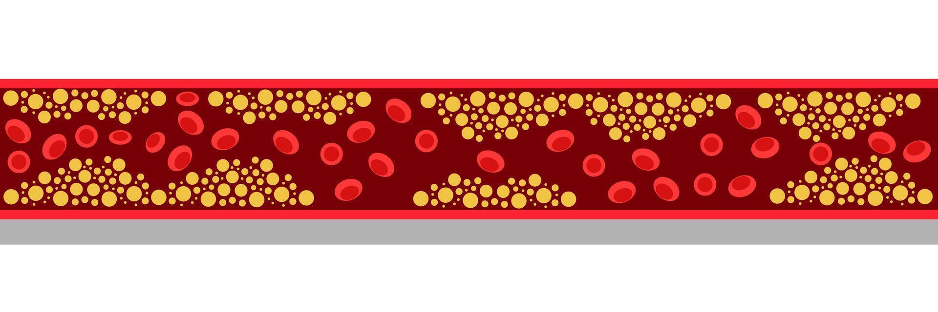 colesterol nivel en obstruido sangre buque médico malo hdl lipoproteína. alto y bajo grasa prueba indicador. aterosclerosis riesgo. cuidado de la salud concepto. vector ilustración