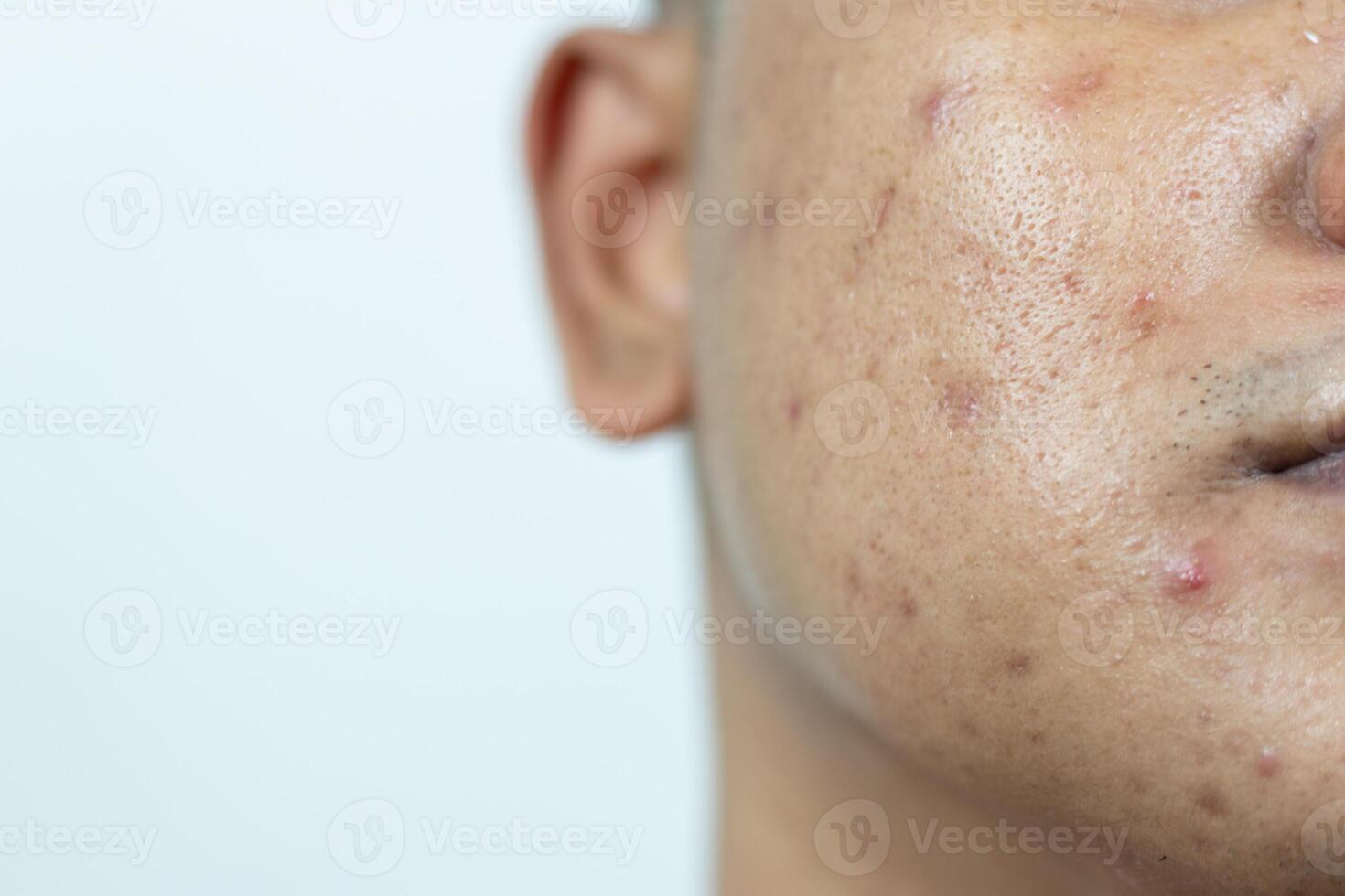 skin problems. problem of inflamed acne on the face. Inflamed acne consists of swelling, redness, and pores that are severely clogged with bacteria, oil, and dead skin cells. photo