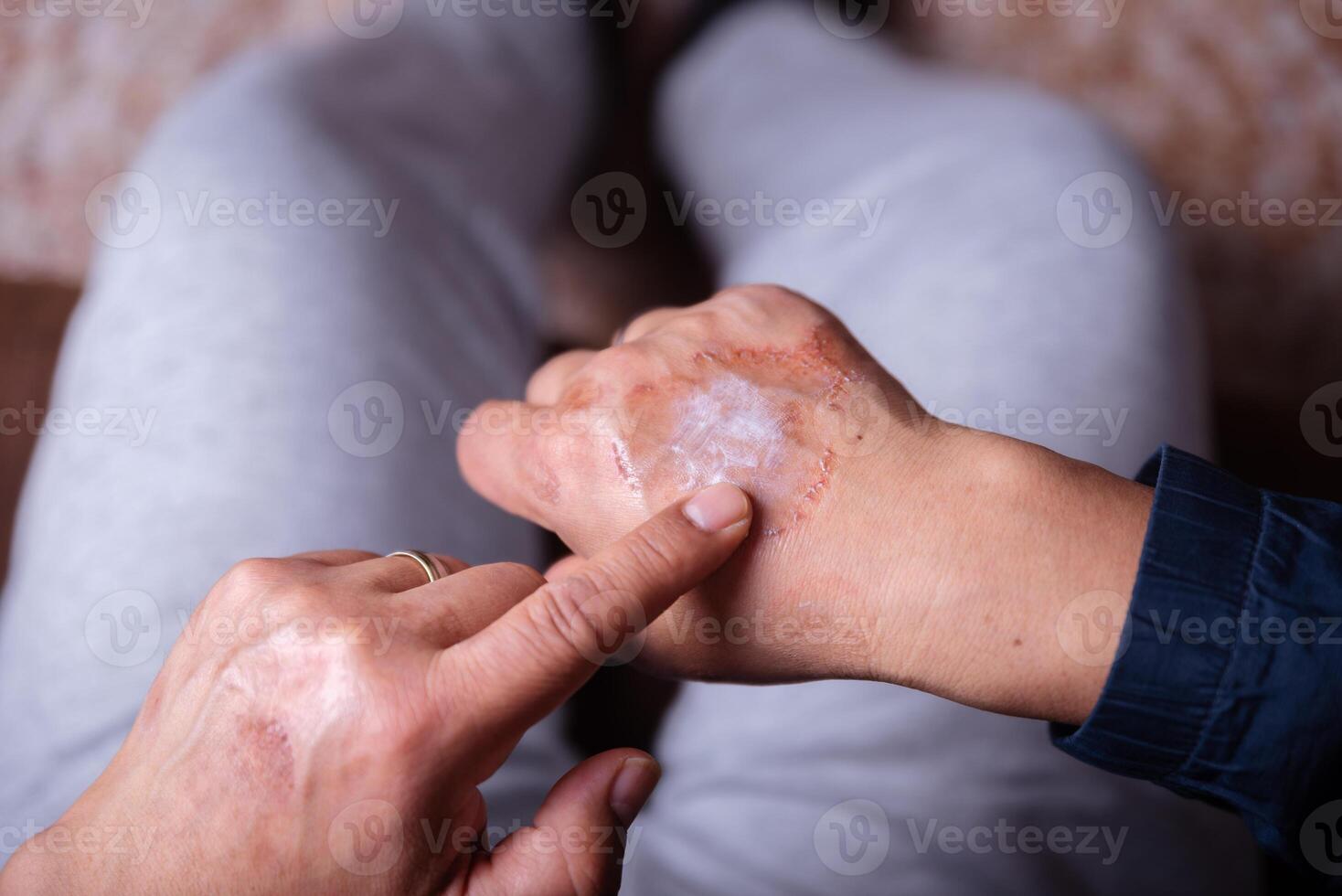 Curing with an allergic reaction cream on the hand. photo