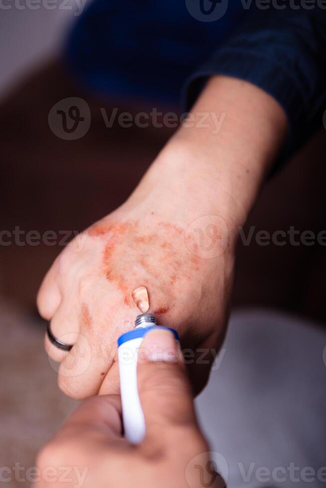 Curing with an allergic reaction cream on the hand. photo