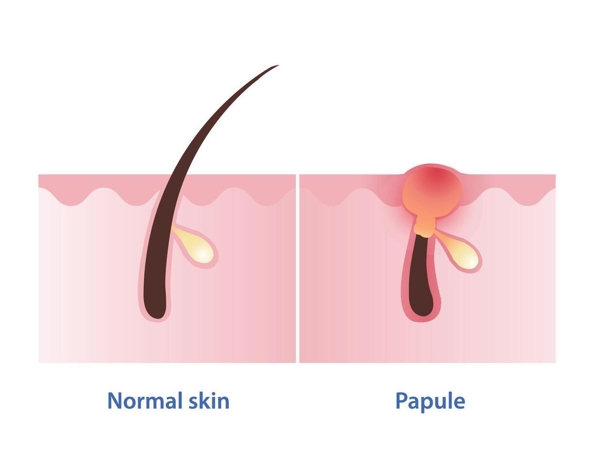 pápula, tipo de inflamatorio acné vector aislado en blanco antecedentes. cruzar sección de normal piel y pápula espinilla es pequeño, sólido, rojo, enconado bache en piel capa. piel cuidado concepto ilustración.