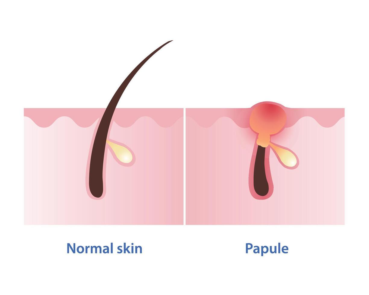Papule, type of inflammatory acne vector isolated on white background. Cross section of normal skin and papule pimple is small, solid, red, inflamed bump in skin layer. Skin care concept illustration.