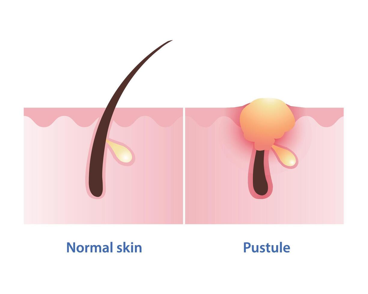 Pustule, type of inflammatory acne develop from papule vector on white background. Comparison of normal skin and pustule pimple is small, inflamed, pus filled, blister like sores on the skin surface.
