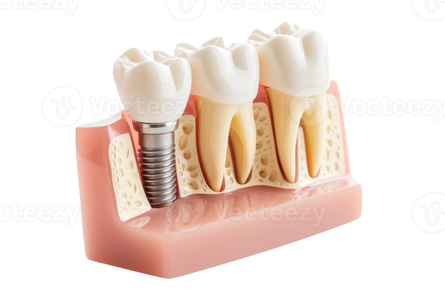 AI generated Dental implant on a transparent background png