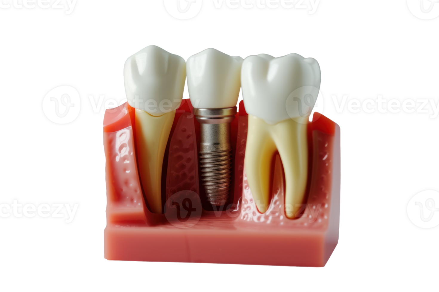 AI generated Dental implant on a transparent background png
