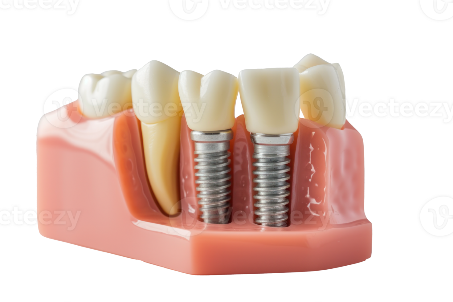 ai généré dentaire implant sur une transparent Contexte png