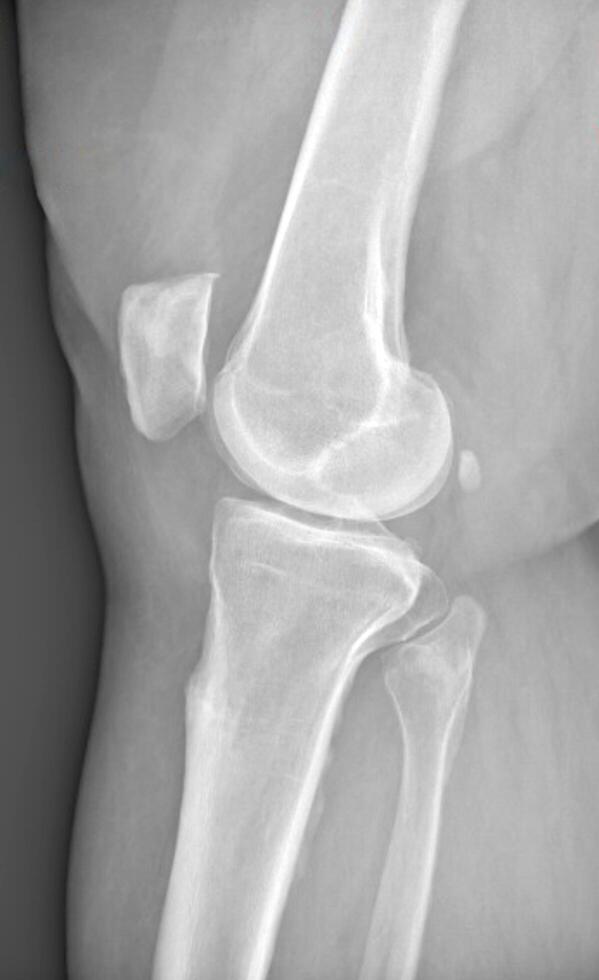 X-ray of the bones of knee of a man. Medical concept. photo