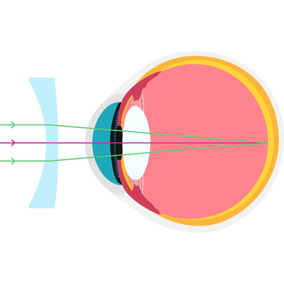 Astigmatic academic diagram structure anatomy vector