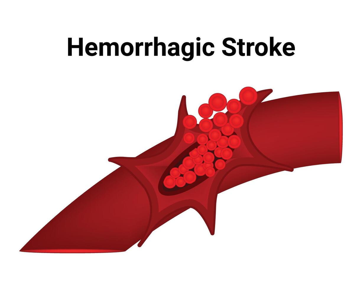 Hemorrhagic Stroke Science Design Vector Illustration Diagram