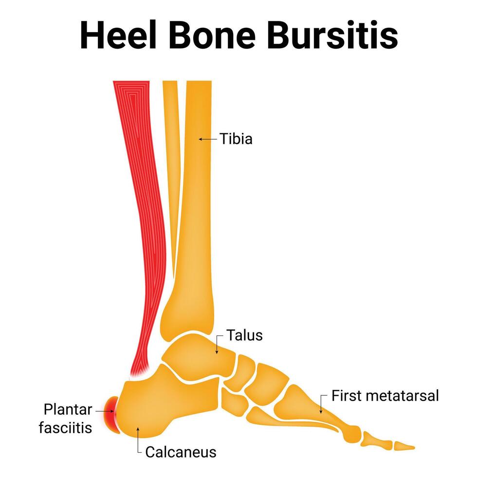 Heel Bone Bursitis Science Design Vector Illustration Diagram