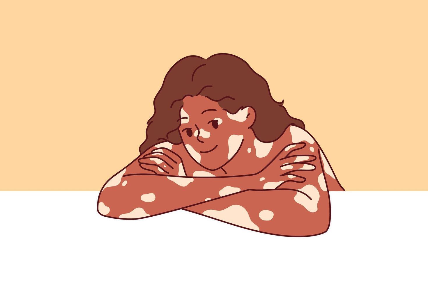 African American woman with vitiligo syndrome and spots on skin, leaning elbows on white surface vector